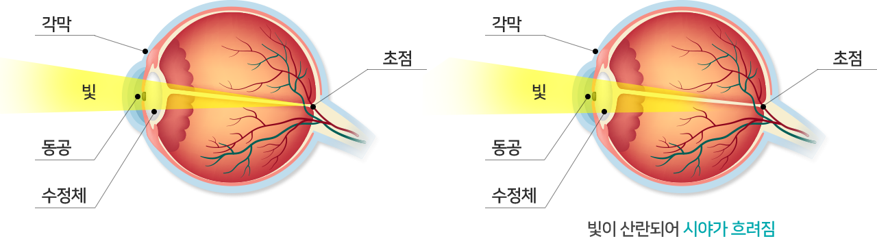 정상안 백내장안 차이